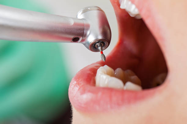 Best Emergency Wisdom Tooth Extraction in Taft Heights, CA